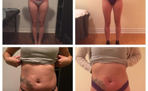 12 I-Lipo Treatments