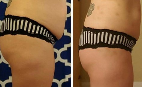 14 I-Lipo Treatments