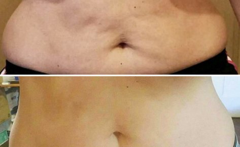 16 I-Lipo Treatments