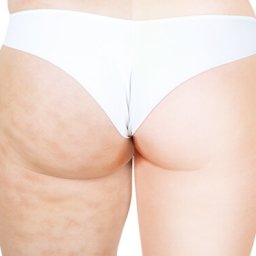 5 Cellulite Removal Treatments